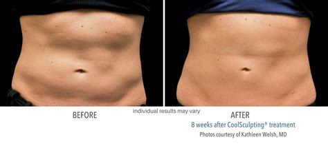 Body Sculpting: Fat Results With Cold, Lasers, and More.